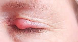 Pictures Of Styes And Chalazia In Your Eye Styes are very similar to infected pimples or ingrown hairs, they just occur on the eyelid, says joshua zeichner, md, director of cosmetic and clinical research in dermatology at mount sinai hospital in new york city. webmd