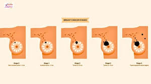 Image result for Breast Cancer Staging
