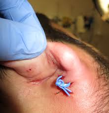Image result for Ear Nerve Block