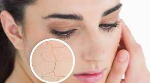 Masalah kulit berjerawat dan berminyak? 5 Masalah Umum Pada Kulit Wajah Dan Cara Mengatasinya Beauty Fimela Com