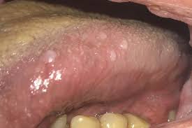 Image result for papillomavirus tongue)