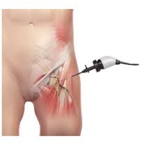 Image result for Snapping Hip