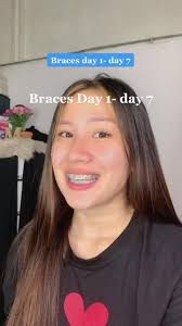 Braces Day 1- Day 7 Journey: First Time Brace Experience