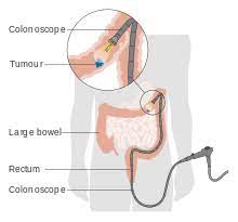 Send thanks to the doctor. Colorectal Cancer Wikipedia