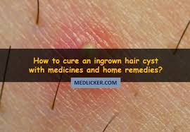 Make sure you soften the hairs and open the pores in. Ingrown Hair Cyst And How To Cure It