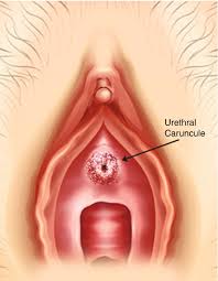 Image result for Urethral Prolapse