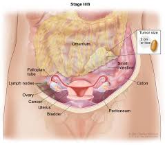 Surgical removal is the most common treatment, but chemotherapy and radiation. Ovarian Fallopian Tube Cancers Hematology Oncology Associates Of Cny