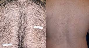 This means that laser hair removal prices in new york are not exactly the same as treatment costs in atlanta. St Louis Laser Hair Removal Price St Louis Cosmetic Surgery