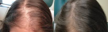 If you are not sure if you should be stopping a medication, please ask. Prp For Hair Loss Philadelphia Non Surgical Balding Treatment