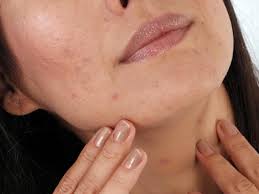 The same test attempted to determine whether or not vitamin a helped acne. Pregnancy Acne Treatments And Home Remedies