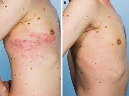 It affects people of all races, genders and ages, which is why it's absolutely critical for americans to learn about. Zosteriform Metastases From Malignant Melanoma Nejm