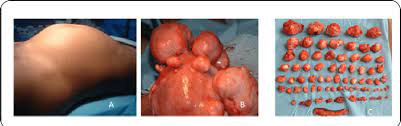 What does a fibroid tumor look like. The Fibroid Tumor Burden In Sub Sahara Africa A Clinical Download Scientific Diagram