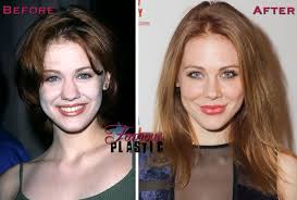 Maitland Ward Nose Job Plastic Surgery Before And After Nose Job Maitland Ward Beautiful Redhead