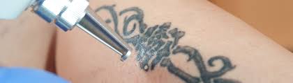 Inkerase understands that each of our clients has their own needs based on tattoo size, ink type, ink depth, skin tone and a series. Tattoo Removal York