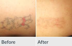 Laser partners is the most trusted name in laser hair removal and tattoo laser partners is northwest arkansas' leading cosmetic laser clinic and your. Before After Photos Genesis Medspa Jefferson City Missouri