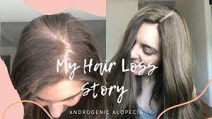 Gradual thinning on top of head. My Hair Loss Story Androgenic Alopecia Youtube