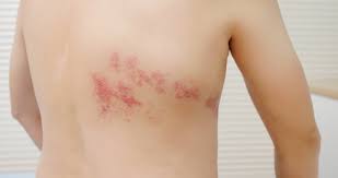 Image result for shingles in children