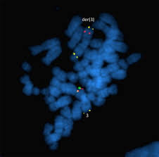 Associated conditions include kidney problems, hearing loss and autoimmune. Mosaic Deletion Duplication Syndrome Of Chromosome 3 Prenatal Molecular Cytogenetic Diagnosis Using Cultured And Uncultured Amniocytes And Association With Fetoplacental Discrepancy Sciencedirect