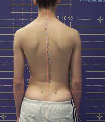 Scoliosis Rolfing In Berlin Munich Practice Stephan Lautz