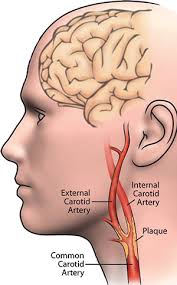 The external carotid artery reduces in size while moving up the neck, giving various branches along the way. Carotid Artery Disease Promedica