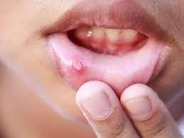 Pengobatan alami dengan bawang putih. 8 Cara Menghilangkan Ulser Mulut Dengan Cepat Dan Berkesan
