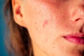 Jenis kulit muka adalah kulit normal, kulit berminyak, kulit kering, kulit sensitif, kulit yang bermasalah. Kenali 3 Masalah Kulit Saat Di Rumah Aja Cari Tahu Penyebab Dan Solusinya