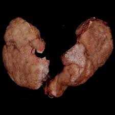 It frequently results in and is the most common cause of hyperthyroidism. Graves Disease Radiology Reference Article Radiopaedia Org