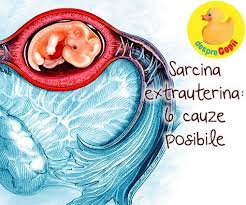 Sarcina extrauterină este o condiţie foarte periculoasă şi o cauză majoră de deces a femeilor gravide, în primul trimestru al sarcinii. Sarcina Extrauterina 6 Cauze Posibile Explicate De Medicul Ginecolog Desprecopii Com
