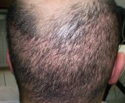 La greffe de barbe répond à un besoin spécifique chez les hommes. Greffe De Cheveux Pas Cher A L Etranger Faites Attention Dhi
