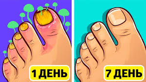 как вылечить грибок на ногах в домашних условиях видео Gribok Nogtej Ischeznet Navsegda S Pomoshyu Etogo Domashnego Sredstva Youtube