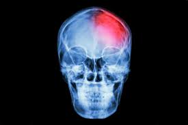 We did not find results for: Traumatic Brain Injury Causes Symptoms Treatment Live Science