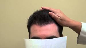 Bay Area Hair Transplant Hair Restoration San Francisco Hair Loss Solutions Hair Transplant Hair Transplant Surgery
