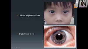 Down Syndrome Youtube