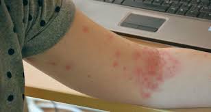 These skin changes are differentiated from each other according to their size. What Are Petechiae And Causes Of Petechiae