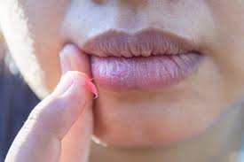 How to get rid of pimples on lips? Tips To Get Rid Of White Spots On Lips Thehealthsite Com