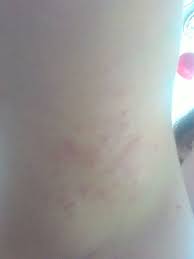 Poyavilis Krasnye Pyatna Pod Myshkoj Vopros Dermatologu 03 Onlajn