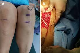 These tendons are the soft tissues that connect the hamstring muscle to the outer part of the knee, and they resting your leg is vital for giving the injury time to heal. Ligament Augmentation Reconstruction System Artificial Ligaments In Patellar Tendon Reconstruction A Chronic Patellar Tendon Rupture After Multiple Operations A Case Report