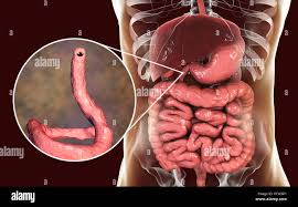 Image result for Hookworm