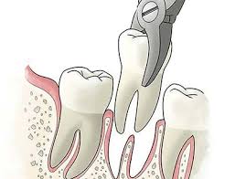 Wisdom Teeth San Marcos Is The Third Set Of Molars That People Generally Get In Their Early Twenties Con Wisdom Tooth Extraction Wisdom Teeth Tooth Extraction