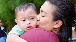 Karakteristik Anak Sindrom Down dengan Keterlambatan Bicara dan Gangguan  Pendengaran