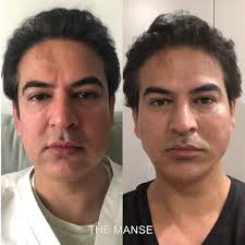 Pdo thread lift before and after. Thread Lift In Sydney The Manse Clinic