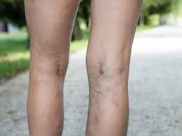 Also, what causes dvt and how to reduce your chances of getting it. Trombosis Venosa El Riesgo De Lo Impredecible Grupo Gamma