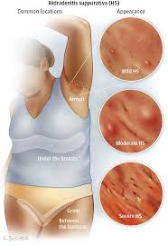 Image Description Not Available Hidradenitis Suppurativa Remedies Dermatology Postpartum Care Kit