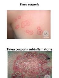 Psoriazisul este greu de vindecat si de cei mai multi homeopati dar este vindecat sau ameliorat substantial totusi caci multi homeopati isi dau seama ce probleme. Sub Der