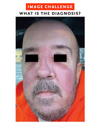 A 44-year-old man with Crohn's disease that was being treated with  infliximab presented with a 2-day history of a facial rash. In the previous  week, his daughter had had a sore throat,