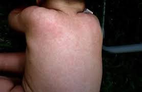 Maybe you would like to learn more about one of these? Timbulnya Bintik Merah Pada Kulit Bayi Nutriclub