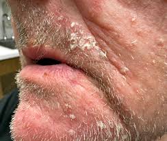 Image result for Beard Dermatitis