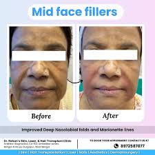 🌟 *Transform your mid-face with fillers and say goodbye to deep nasolabial  folds and marionette lines!🌟 Mid-face fillers are specifically designed to  address volume loss and enhance contour in the cheek area.