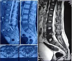 Image result for Spinal Infection