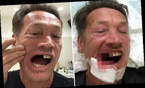 I'm done with the uk. Pictured Eastenders Apos Sid Owen Unveils Gory Aftermath Of Golf Accident Talkcelnews Com